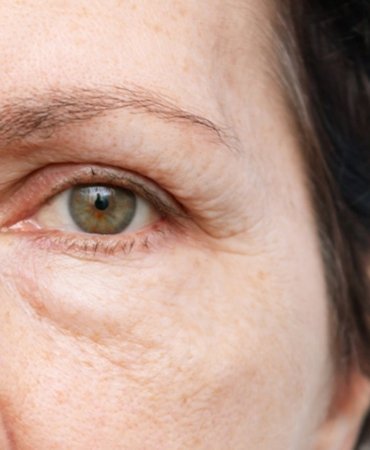 1750658952_goz_alti_sisligi